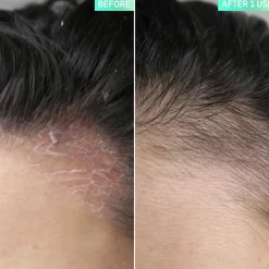 The INKEY List Hiustenhoito<Salicylic Acid Exfoliating Scalp Treatment kuorinta hiuspohjalle 150 ml
