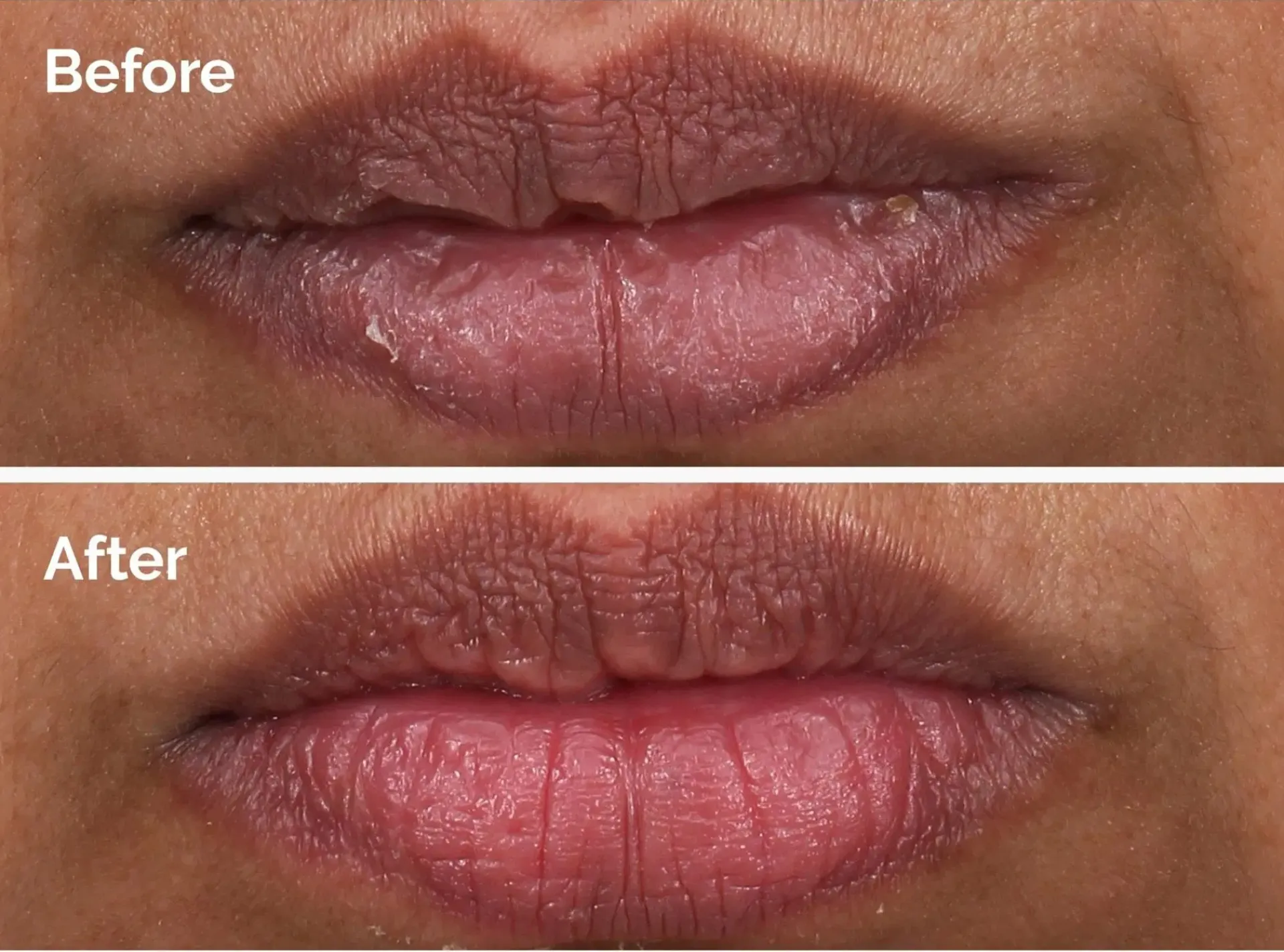 The Ordinary Kasvojenhoito<PHA 5% Exfoliating Lip Serum huuliseerumi 15 ml